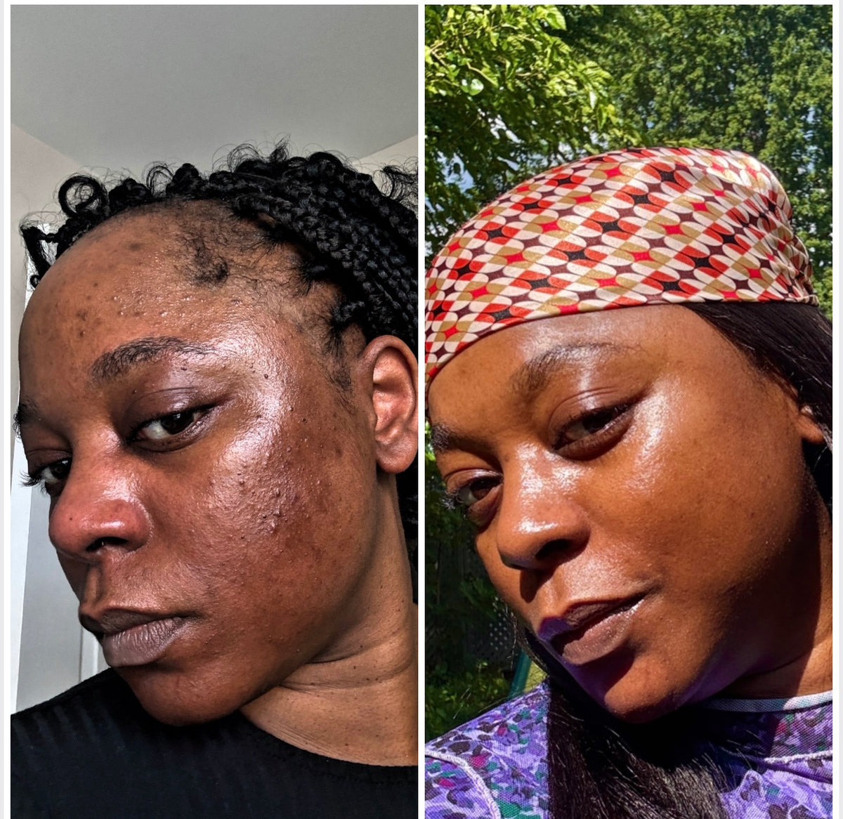 Dark Spot & Hyperpigmentation Face Set (Oily & Acne-prone skin)