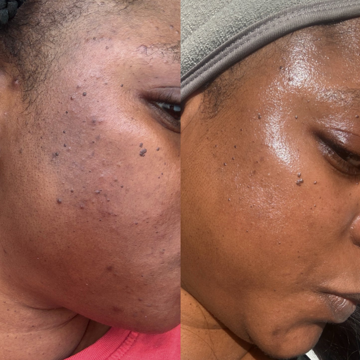 Dark Spot & Hyperpigmentation Face Set (Oily & Acne-prone skin)